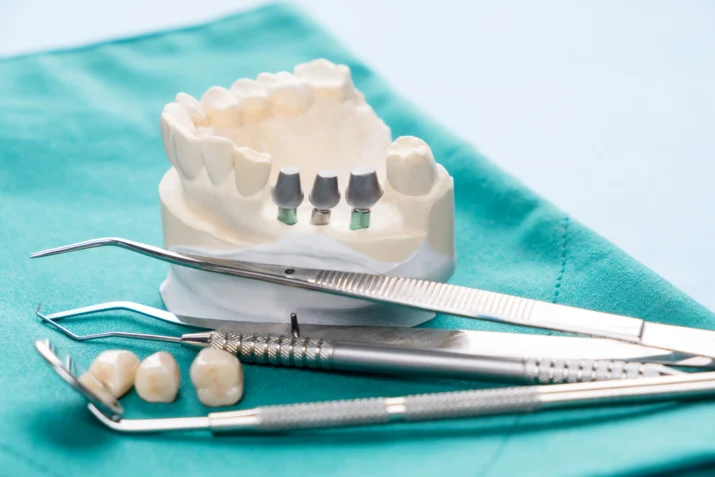 acnis implant dentaire 03